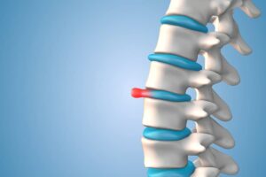 slipped disc