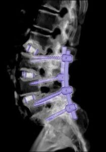Lumbar Spinal Fusion