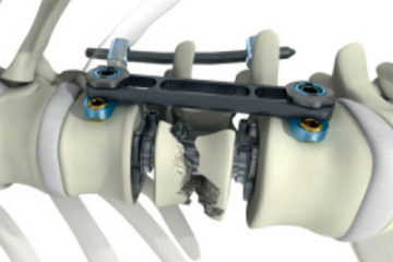 TYPES OF SPINAL IMPLANTS AND WHY YOU MIGHT NEED IT