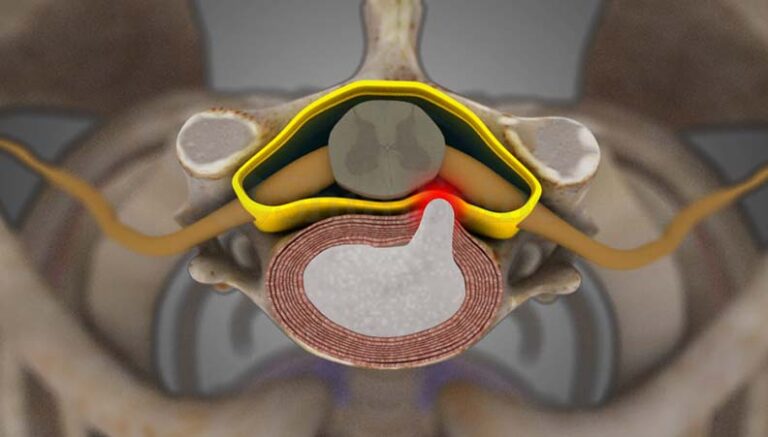 Cervical Disc prolapsed - Ishaan Ortho and Spine Clinic Bangalore