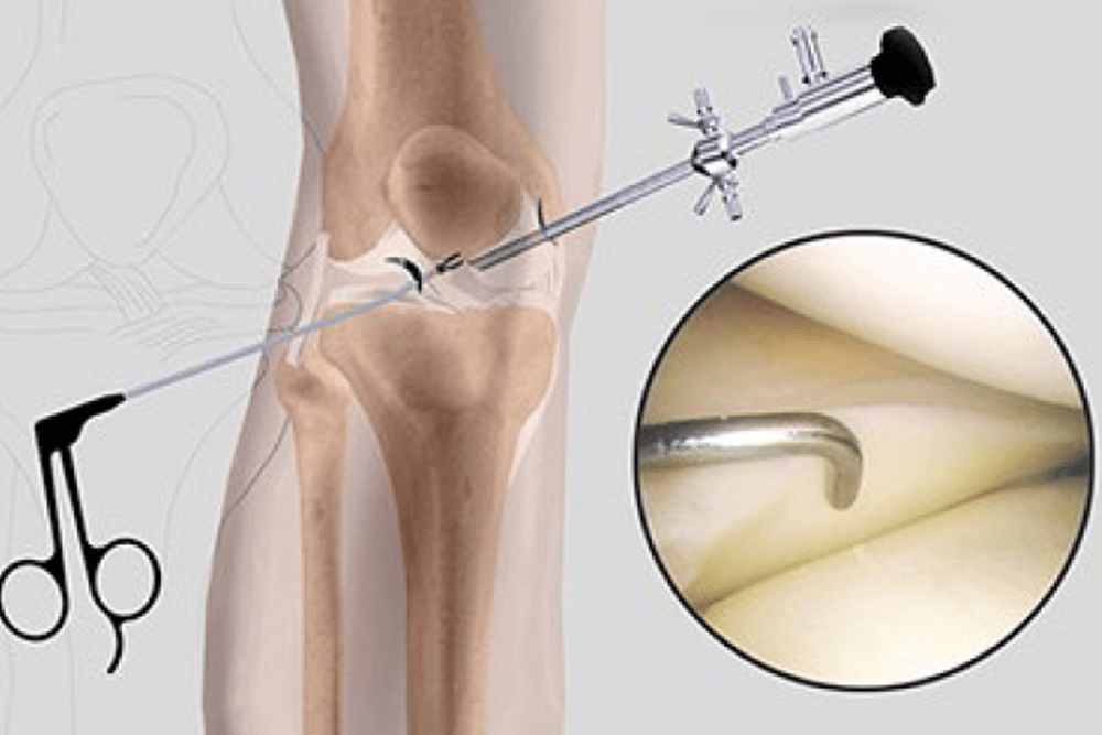 Arthroscopy of Knee