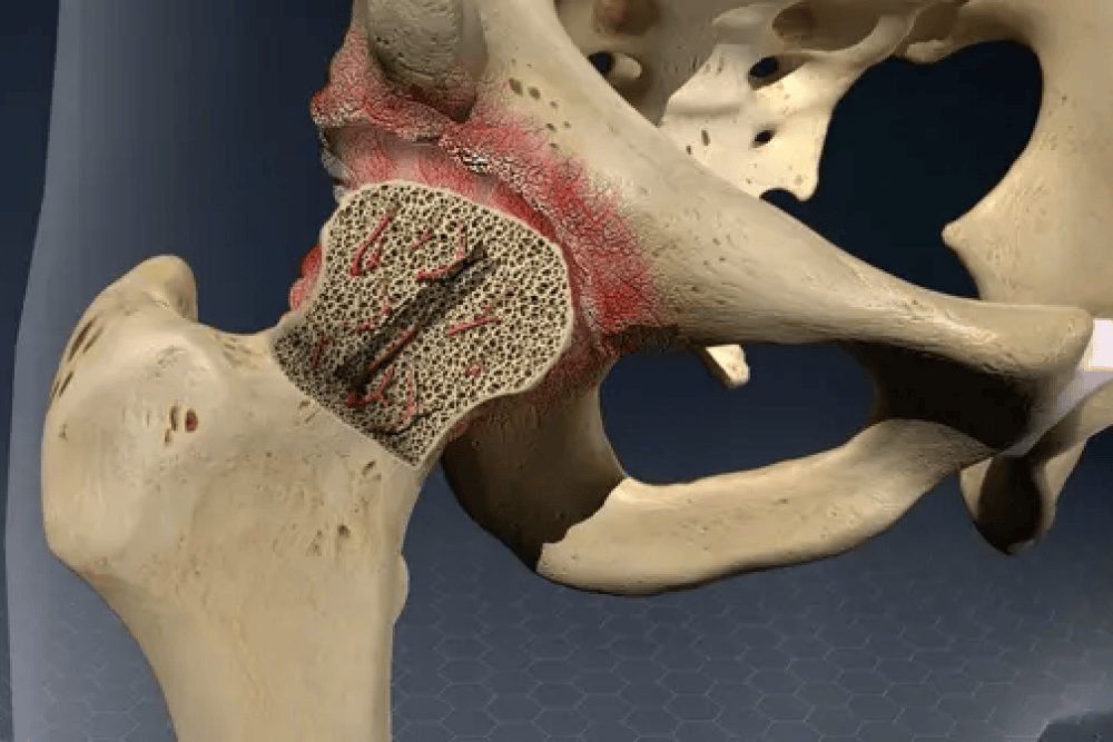 Avascular Necrosis Treatment in Bangalore