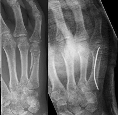 Small Bone Fracture Treatment in Bangalore