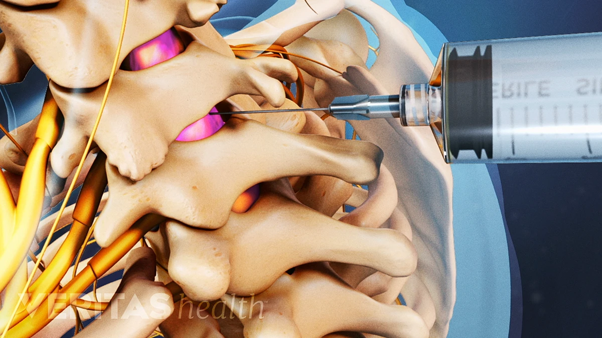 Epidural Steroid Injections