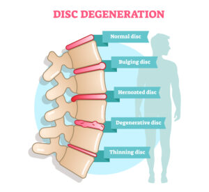 Degenerative Disc Disease: Understanding the Condition and Treatment