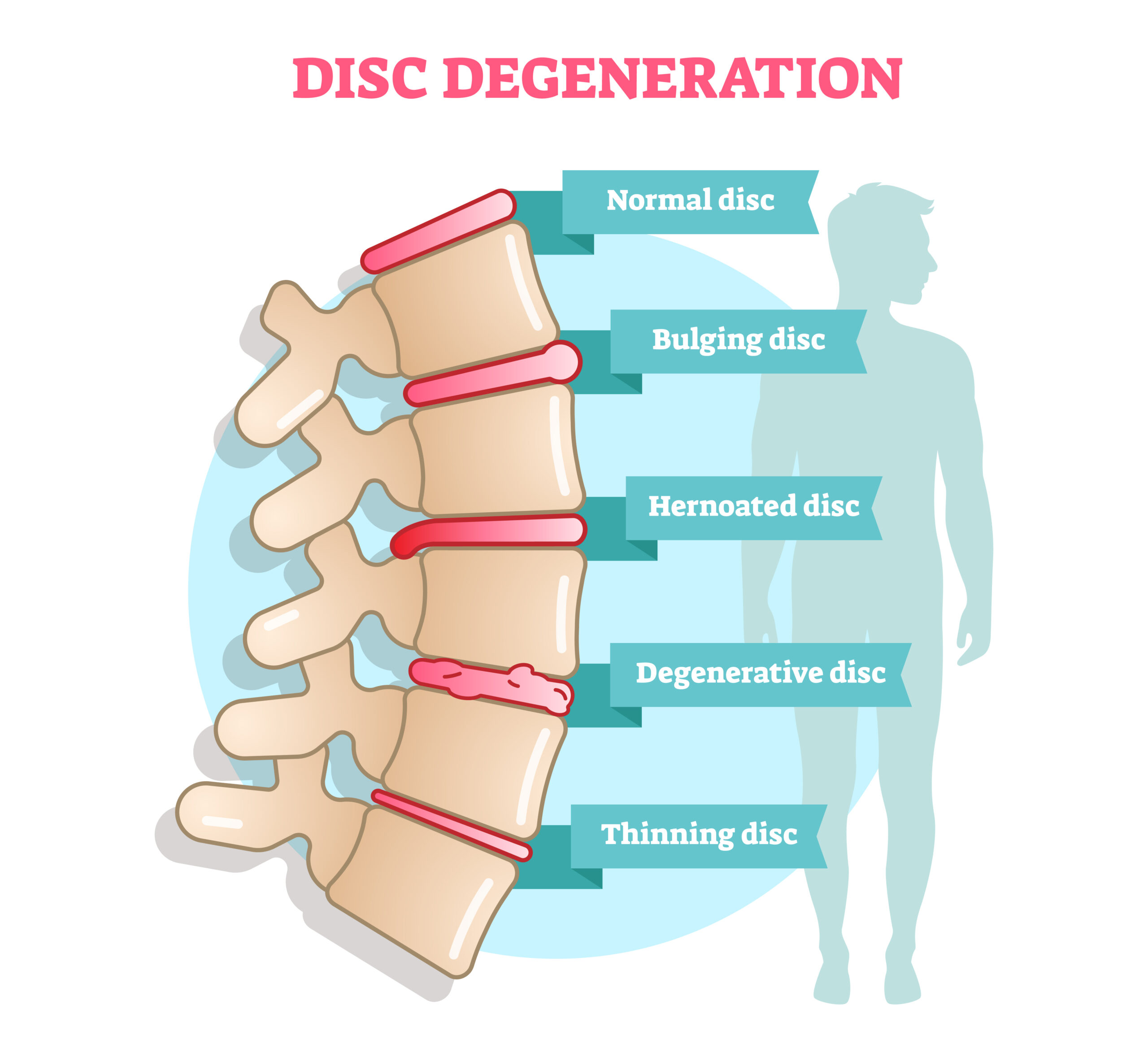 Degenerative Disc Disease