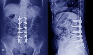 Common Myths and Facts About Spine Surgery