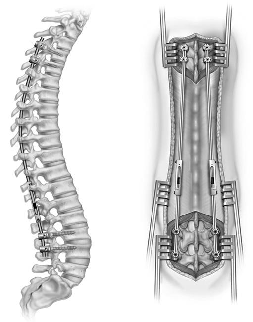 Neuromuscular Scoliosis