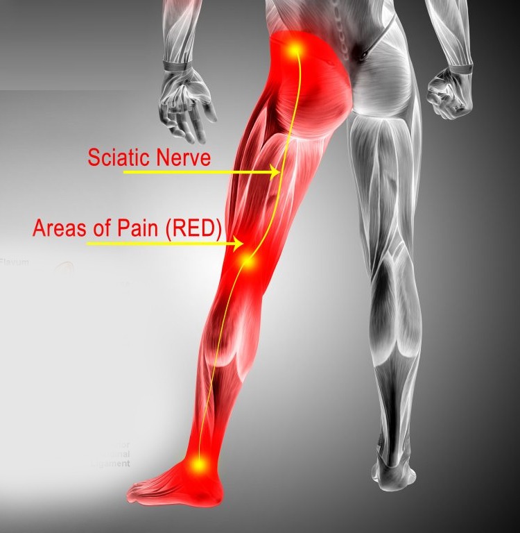 Sciatica | Is it Getting Serious? Warning Signs You Shouldn’t Ignore