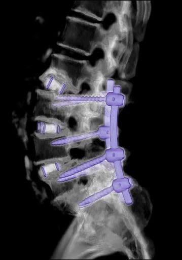 Lumbar Spinal Fusion