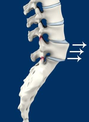 Living with Spinal Instability: How Disc Fusion Can Help Restore Stability and Mobility