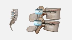 Disc Fusion Surgery Explained: When Is It Needed and What Can Patients Expect?