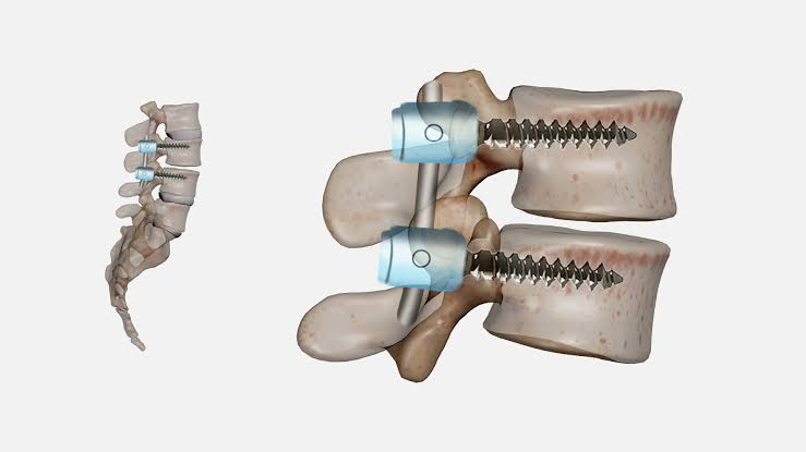 Disc Fusion Surgery Explained: When Is It Needed and What Can Patients Expect?